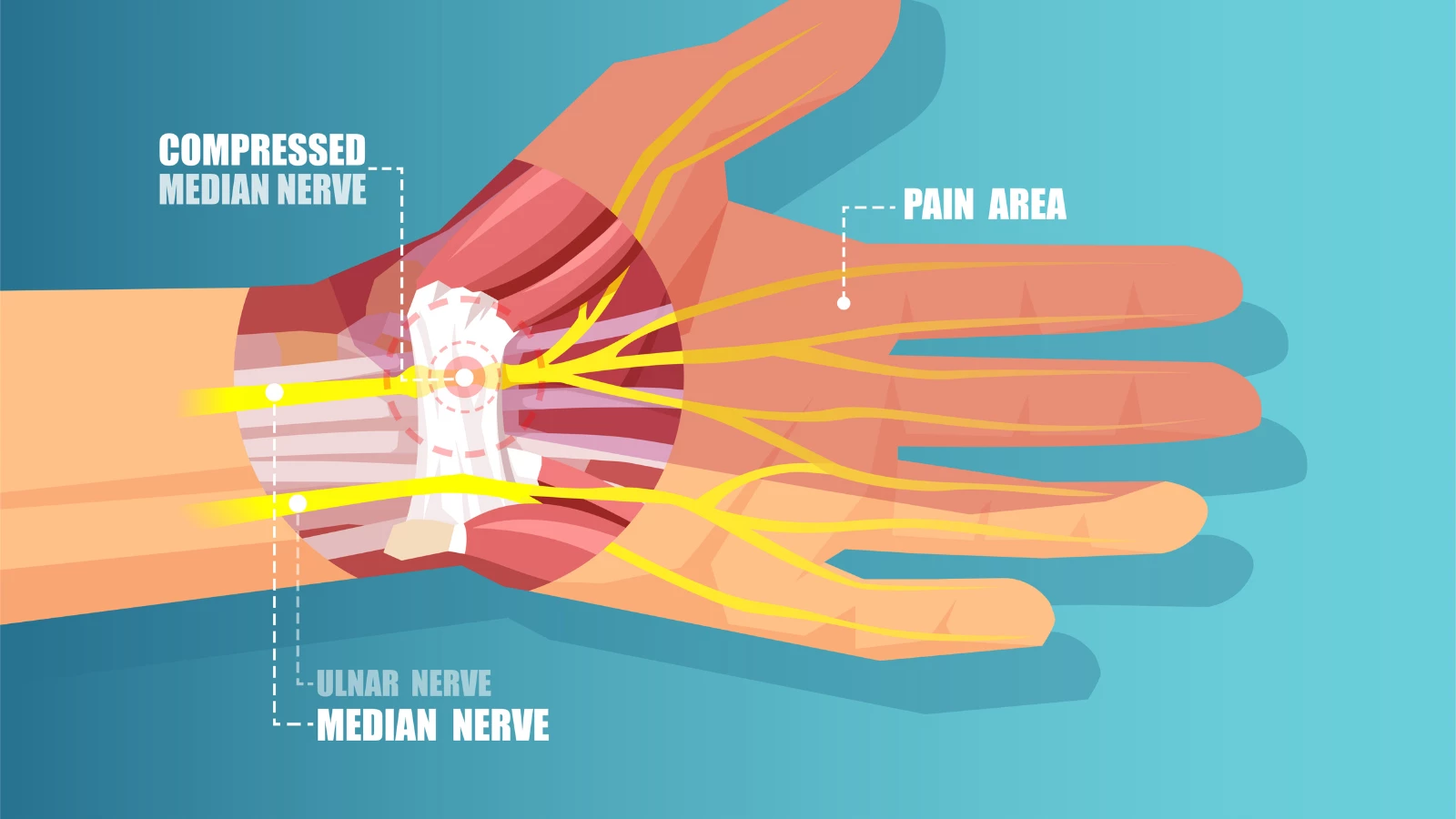 illustration of median nerve carpal tunnel syndrome