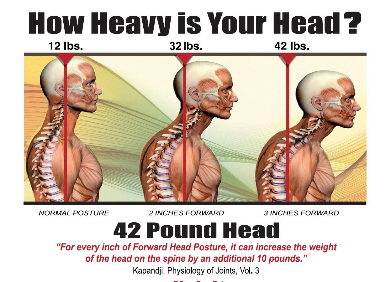 What You Need to Know about Posture and Dowagers Hump