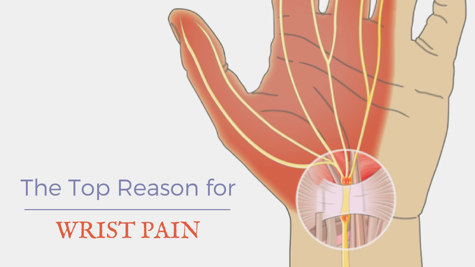 The Top Reason for Wrist Pain (and 5 Other Common Causes