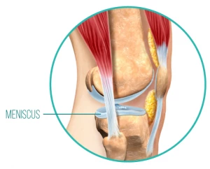 An anatomical diagram of the meniscus, a piece of cartilage between the bones, which can be damaged when the surrounding musculature of the knee joint is not strong or supportive enough