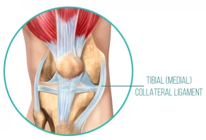 An anatomical diagram of the tibial (medial) collateral ligament, which supports the knee from the inside, and can be strained when the knee joint is not mobile 