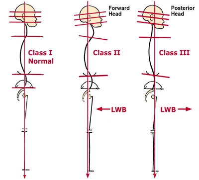 Yoga Anatomy: Different Types of Forward Head Posture and How to Work with  Them - YogaUOnline