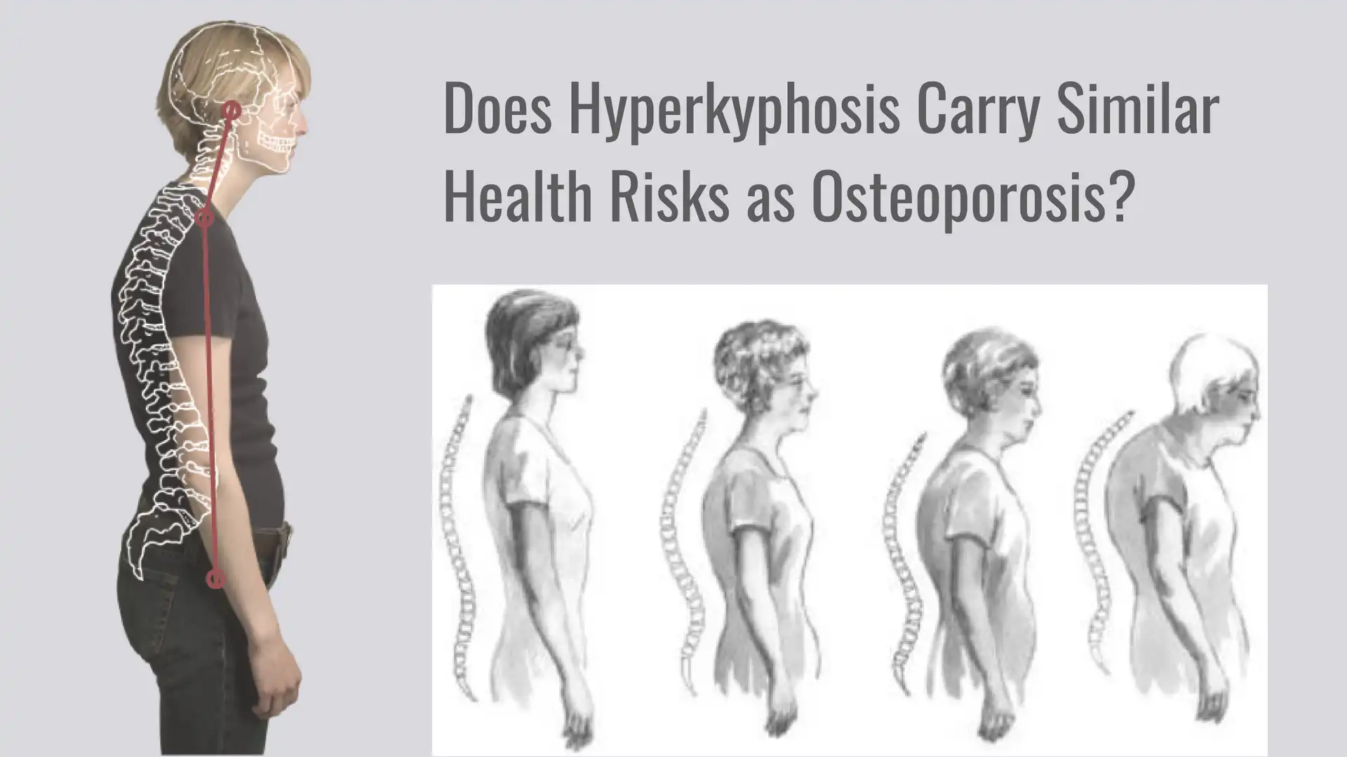 Hyperkyphosis image and the concept of yoga to improve posture and overall health and well-being.