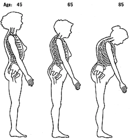 Anatomy graphic showing women's skeletal posture as they age