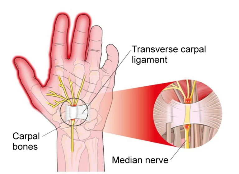 Carpal Tunnel, anatomy of the pinched nerves, yoga for carpal tunnel syndrome