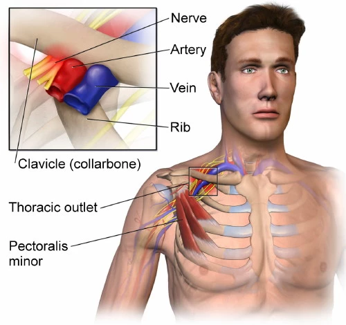 Carpal Tunnel Syndrome, Neck, arm and back anatomy, compressed nerves, how yoga might help