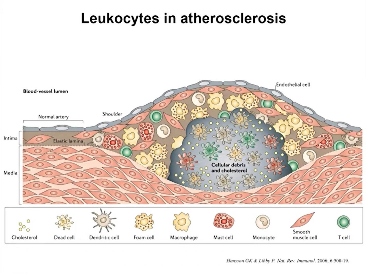 altherosclerosis, waste, plaque build up, leukocytes ( immune system cells)