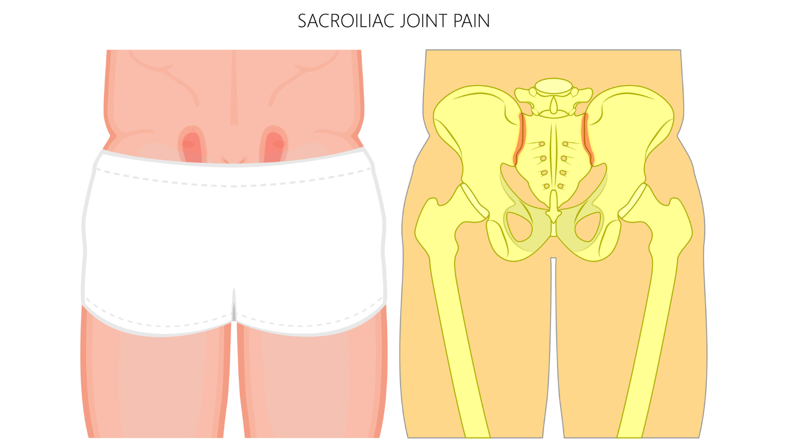 Graphic showing the location of the SI Joints and potential pain points if the SI joint is hurt from yoga or other injuries