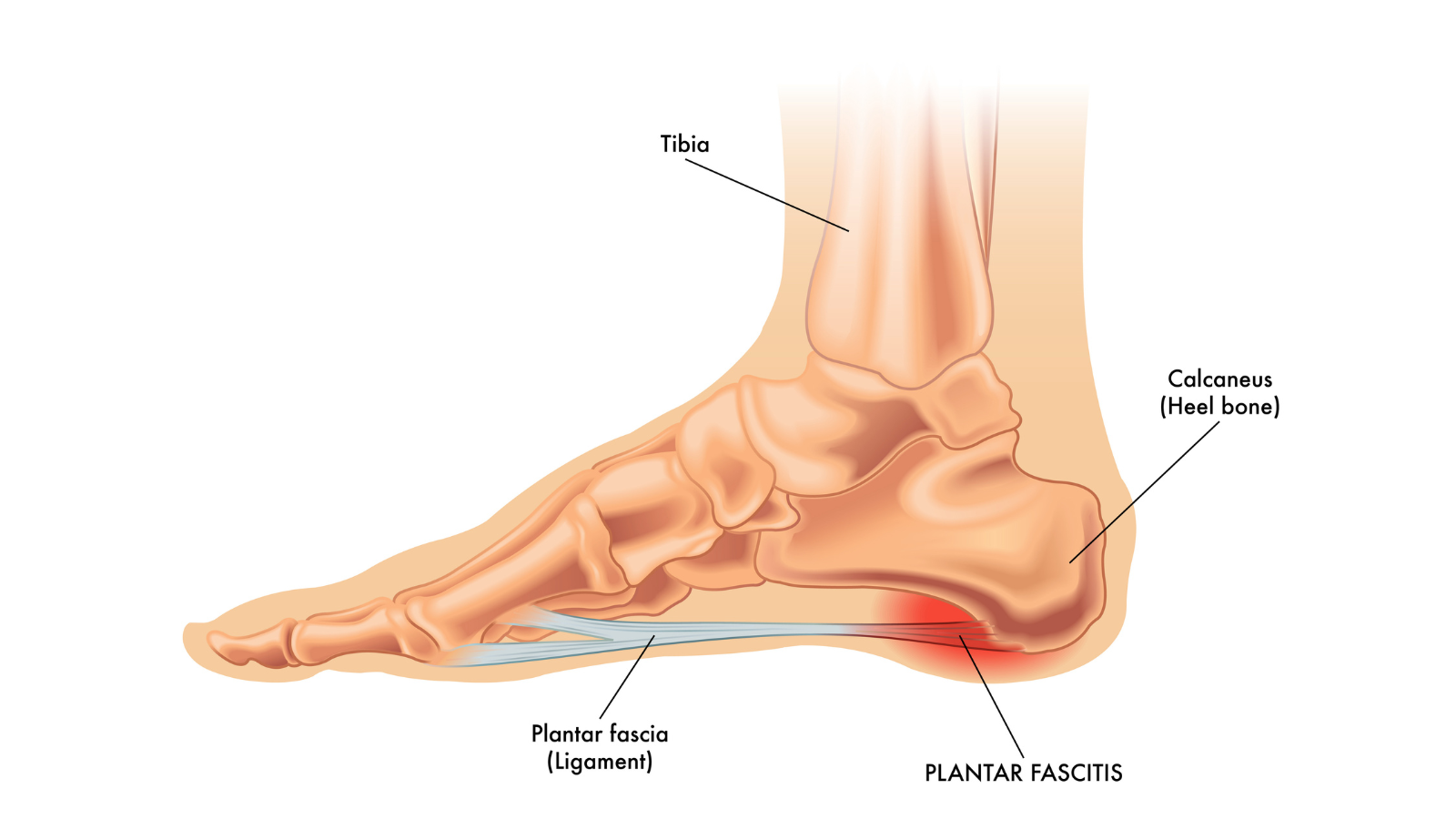 Image depicts illustration of the foot and the condition plantar fasciitis.