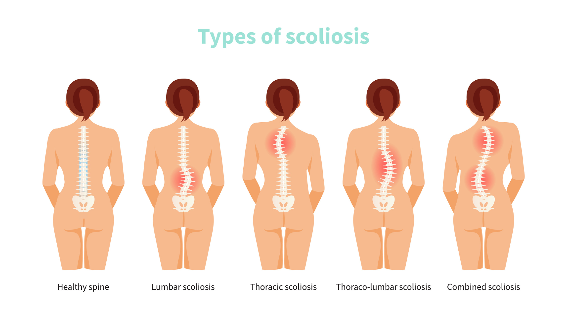 Female anatomy with different types of scoliosis. Medical vector illustration. Includes image of healthy spine