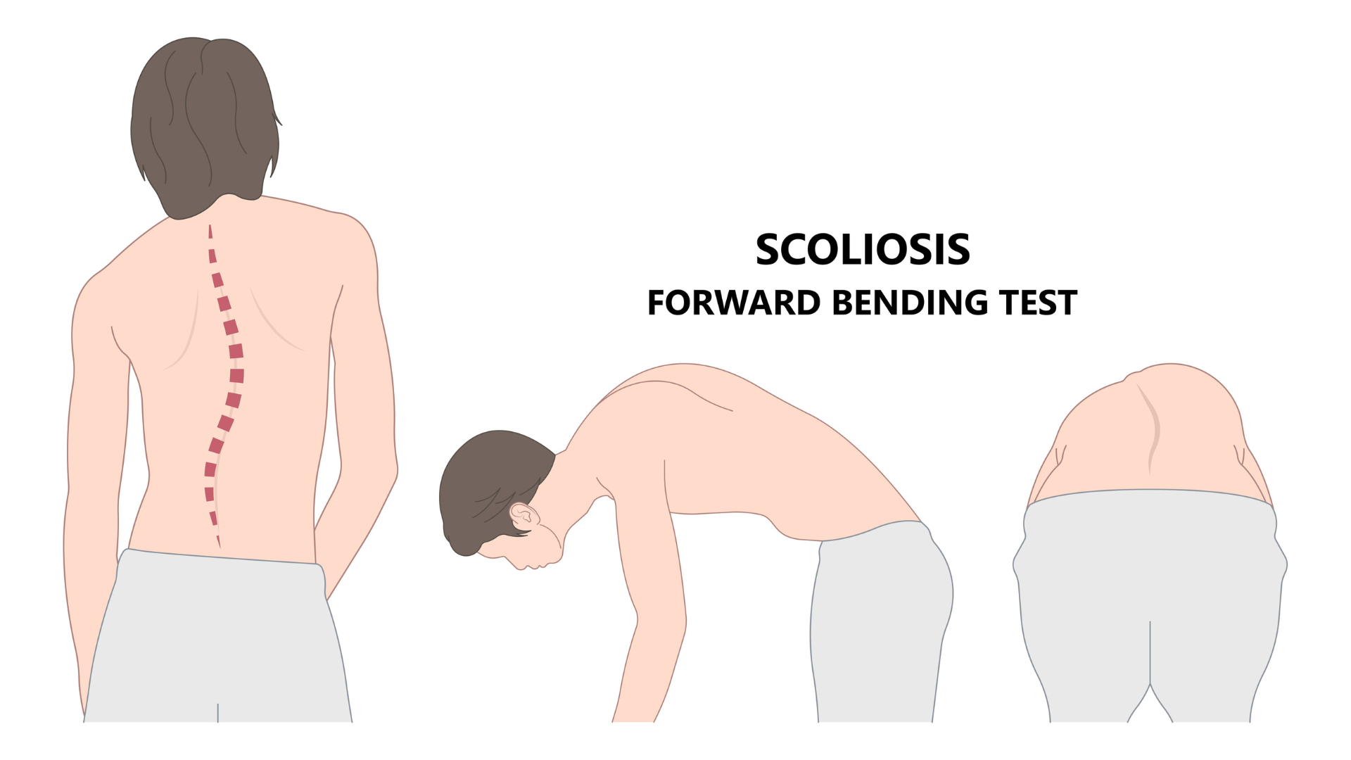 The Adam Forward Bend Test is used to analyze the scoliosis patient.