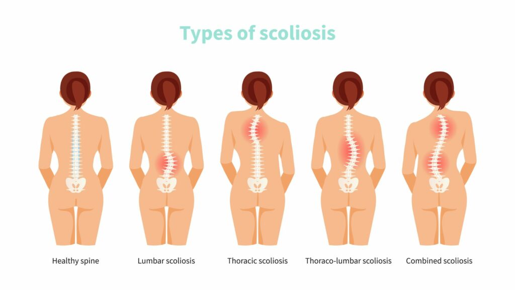 How To Sit In A Chair With Scoliosis? - Posture Tips