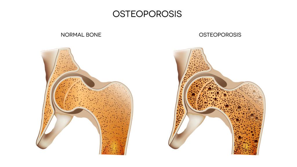 Osteoporosis, Vertebral Fractures and Dowager's Hump—The Role of  Hyperkyphosis - YogaUOnline