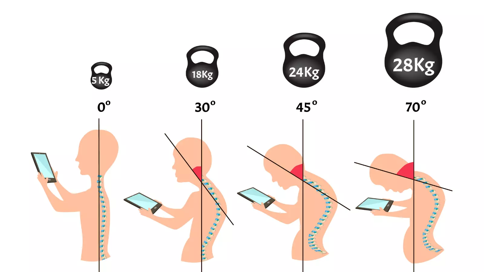 Improper posture symptoms. Text Neck Syndrome. Spinal curvature, kyphosis, lordosis, scoliosis, arthrosis.