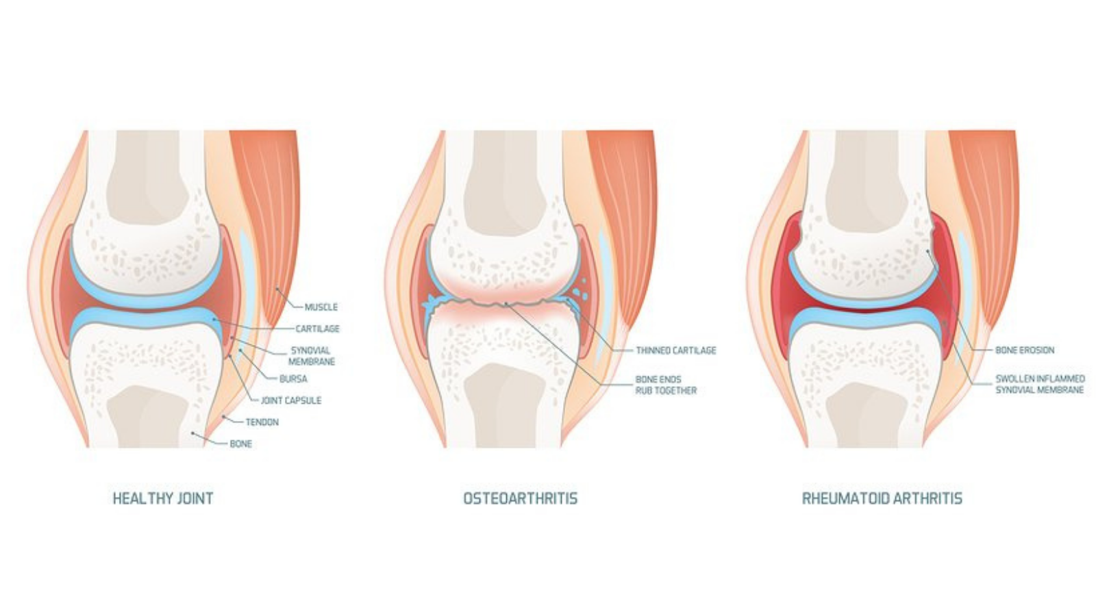 A graphic displaying a healthy joint, a joint with osteoarthritis, and a joint with rheumatoid arthritis.