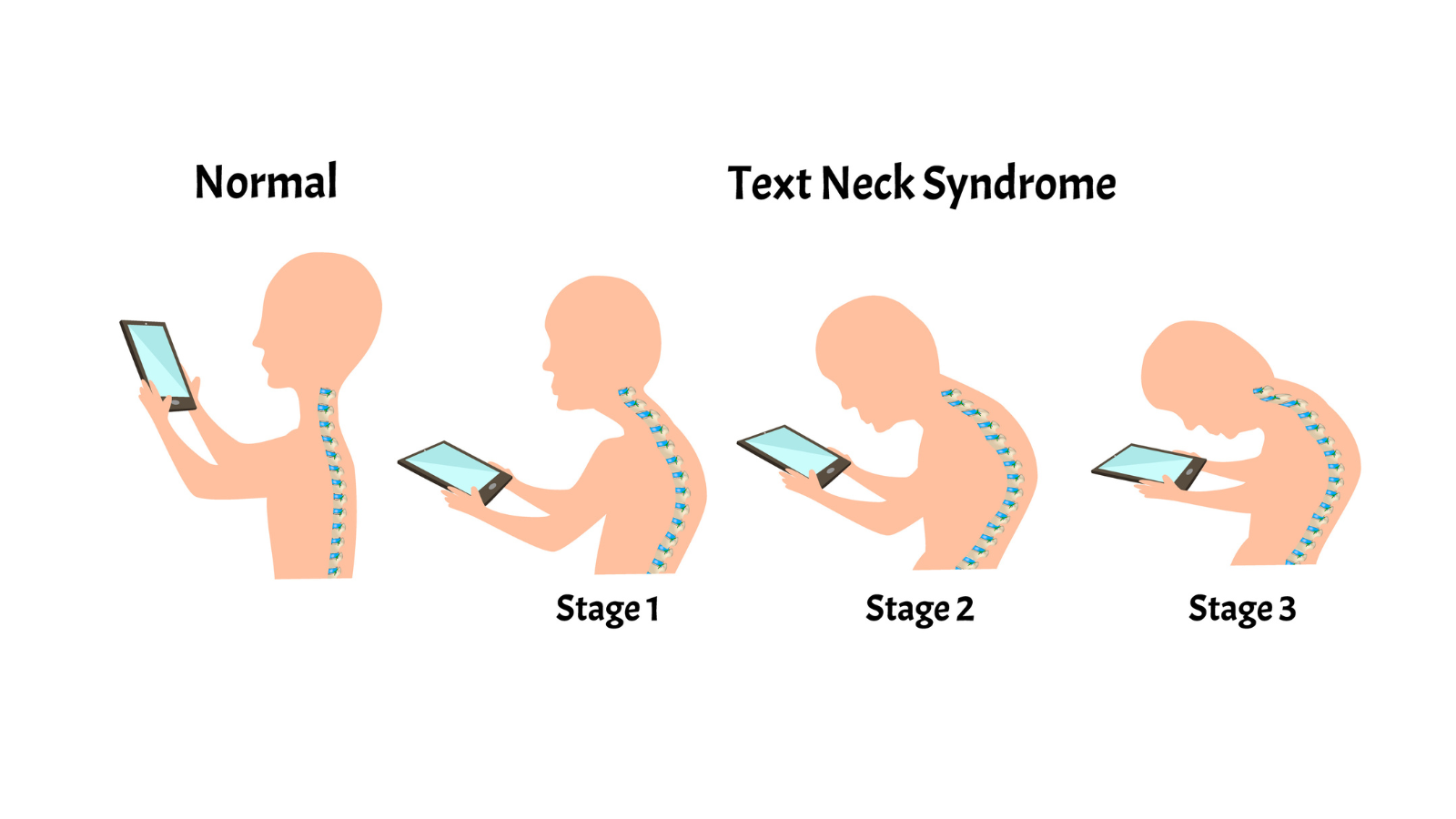 Improper posture symptoms. Stage Text Neck Syndrome. Spinal curvature, kyphosis, lordosis, scoliosis, arthrosis.