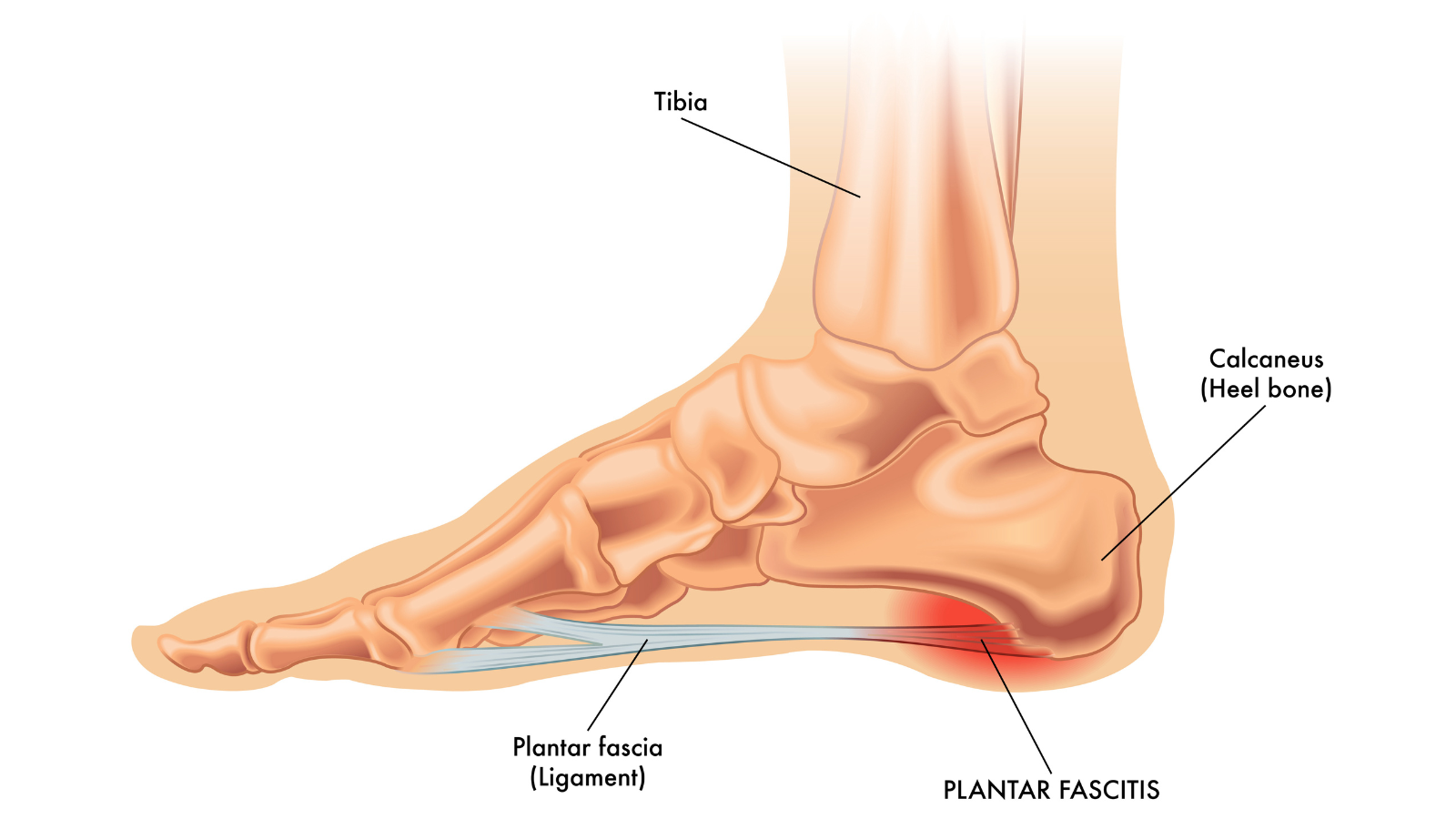 Anatomy illustration of the foot and the origin of Plantar Fasciitis pain.