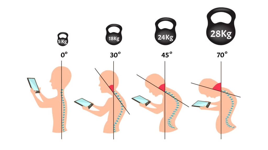 Improper posture symptoms. Stage Text Neck Syndrome and neck pain. Spinal curvature, kyphosis, lordosis, scoliosis, arthrosis. Improper posture and stoop. Infographics.