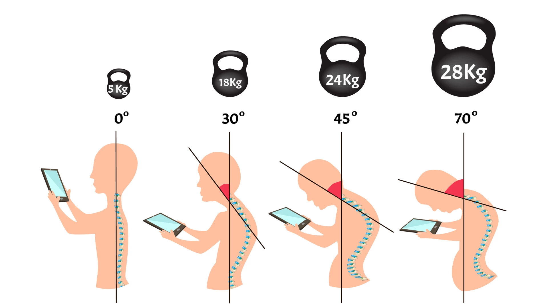 Improper posture symptoms. Text Neck Syndrome. Spinal curvature, kyphosis, lordosis, scoliosis, arthrosis. Improper posture and stoop. Infographics.